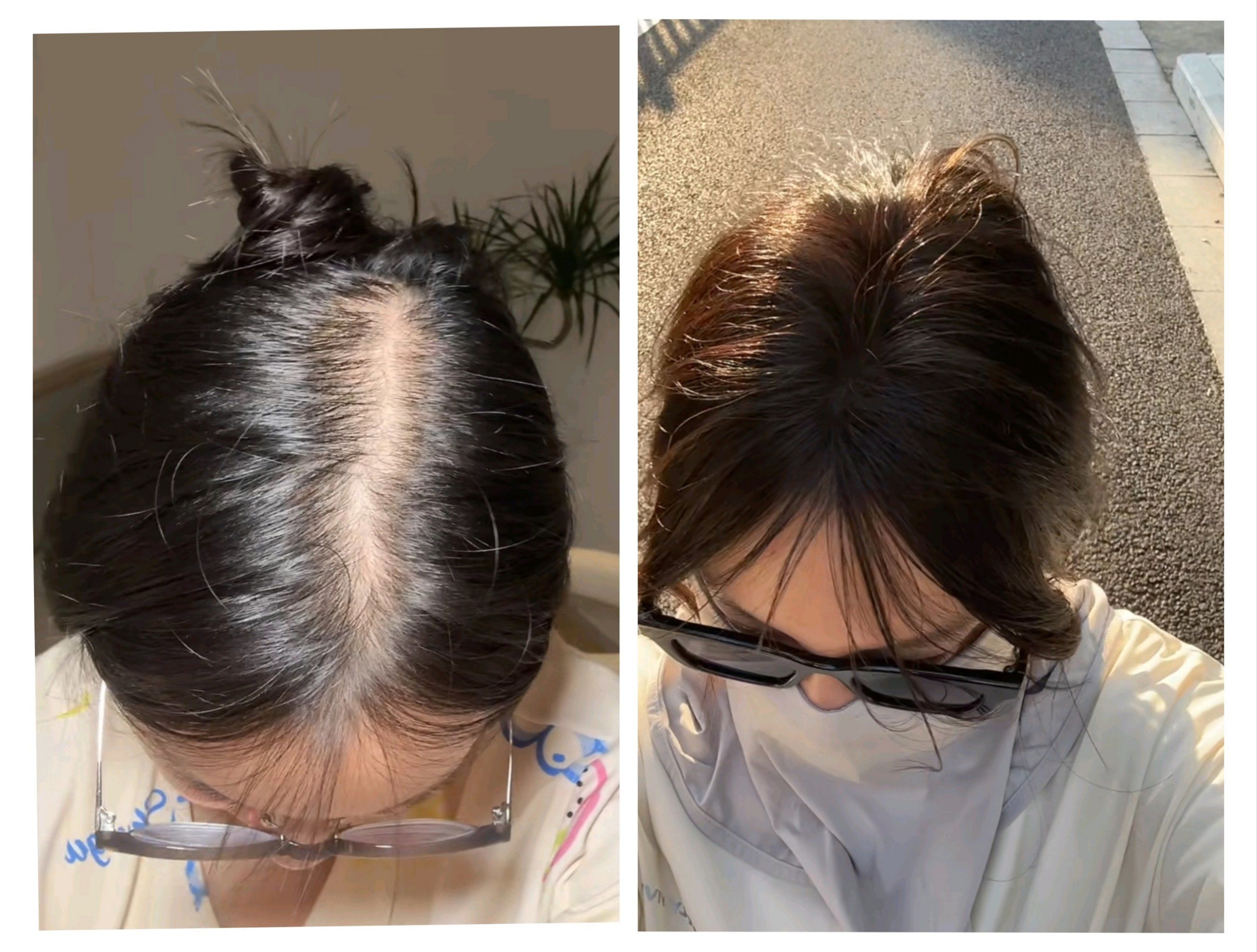 看历史:梅毒是如何引领“假发”成为欧洲时尚?...