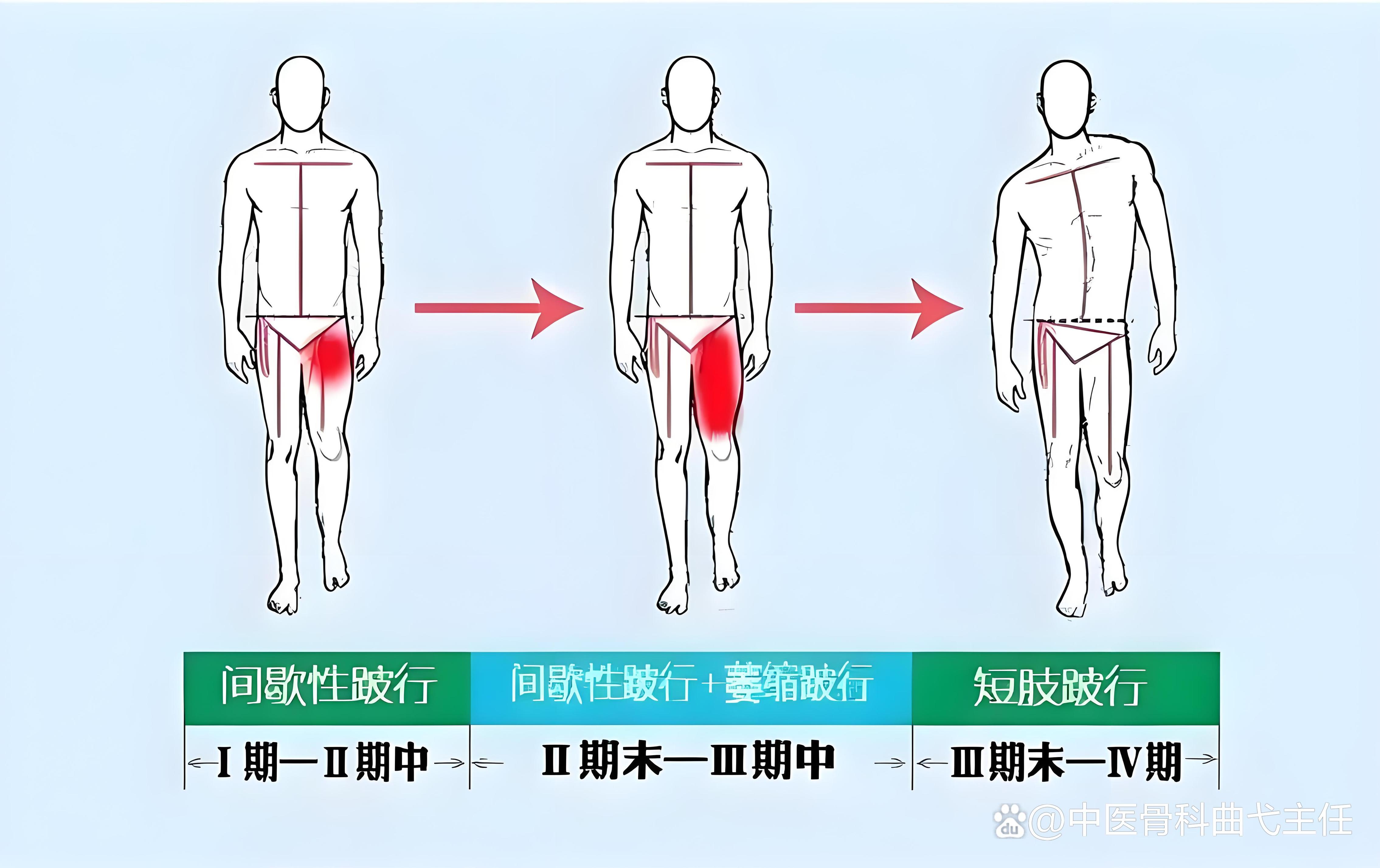为什么人类进化过程中失去的骨头再次出现?...