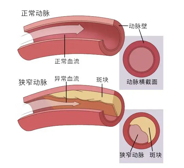 血管斑块有什么危害 如何消除血管斑块